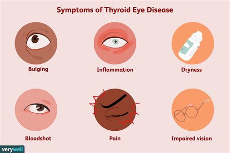 The dhilab medical symptom checker helps you understand the possible causes of symptoms in children and adults. Thyroid Eye Disease: Symptoms, Causes, Diagnosis, and ...