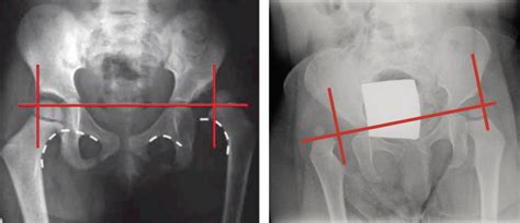 radiografia de cadera normal canvas link