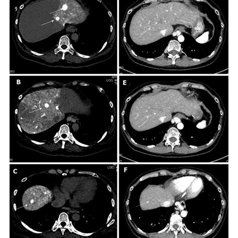 The Representative Dynamic Contrast Enhanced Computed Tomography Images