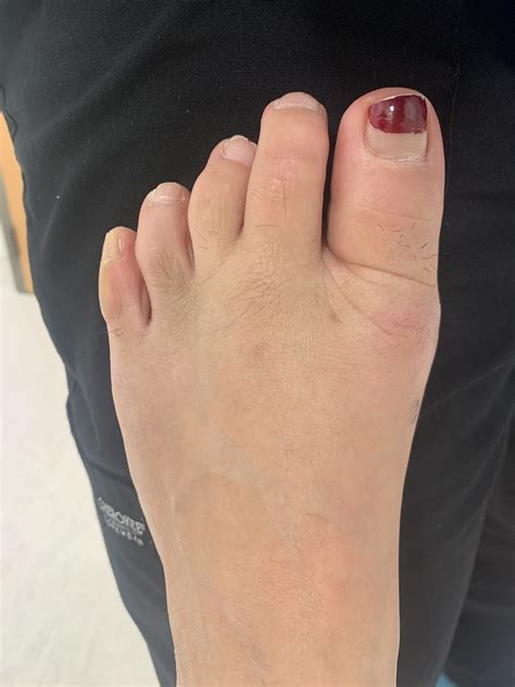 Bunion Surgery Before And After Photos Northwest Surgery Center