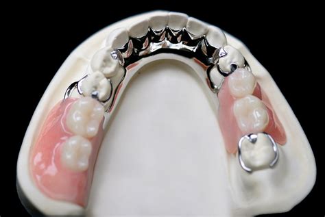 Removable Partial Dentures