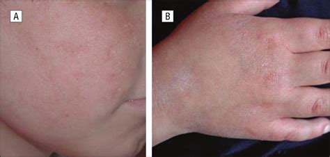 Granulomatous Dermatitis In Common Variable Immunodeficiency With