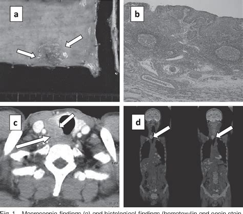 Figure 1 From A Case Of Isolated Thyroid Metastasis Of Esophageal