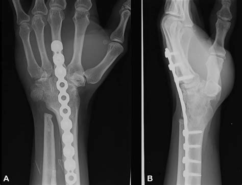 Two Years Following Wrist Fusion In A Patient With Rheumatoid Arthritis Download Scientific