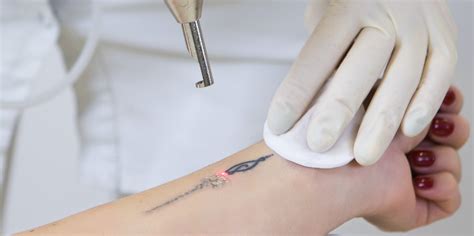 The Latest Innovations In Tattoo Removal Inside Out