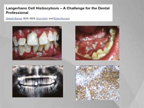 Periodontitis As A Manifestation Of Systemic Diseases Ppt