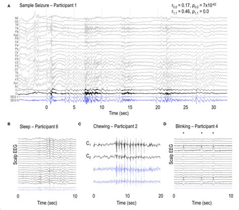 Sample Eeg Recordings A Sample Seizure In Participant 1 And