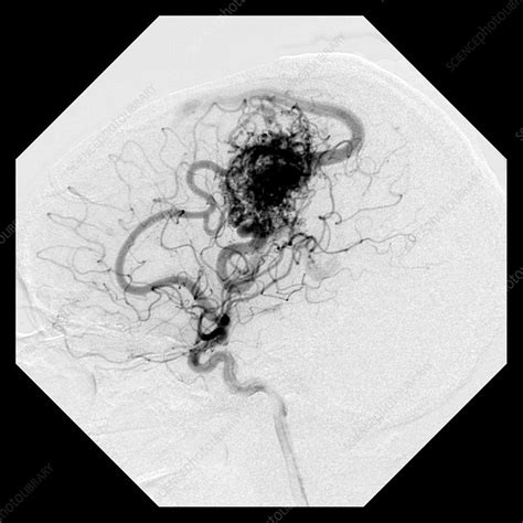 Cerebral Angiogram Of Avm Stock Image C0271580 Science Photo Library