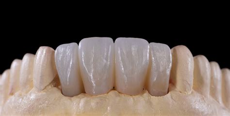 Aesthetic All Ceramic Restoration Crystal Dental Design