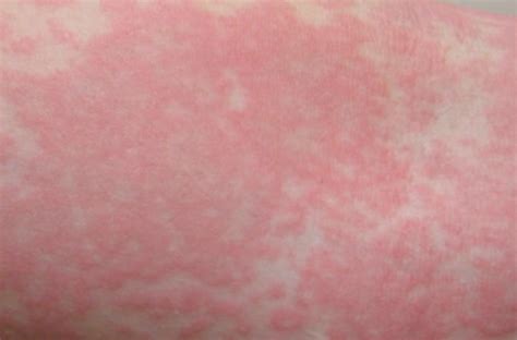 What Does An Allergic Reaction Rash Look Like Pictures
