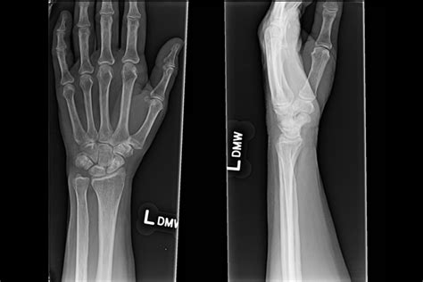 Ortho Dx Treatment For A Comminuted Scaphoid Fracture Clinical Advisor