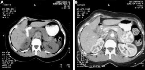 Abdominal Ct Scan Without A And With B Contrast Medium Note The
