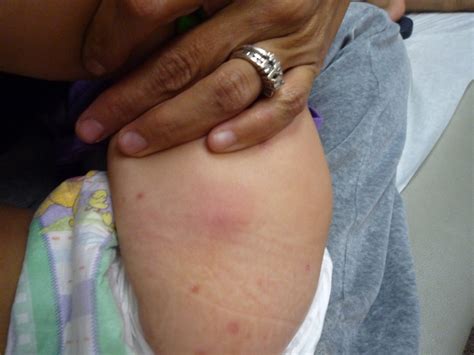 Mrsa germs can get into a skin injury, such as a cut, bite, burn or scrape. Lil Farrah Mae's MRSA story: What is MRSA?