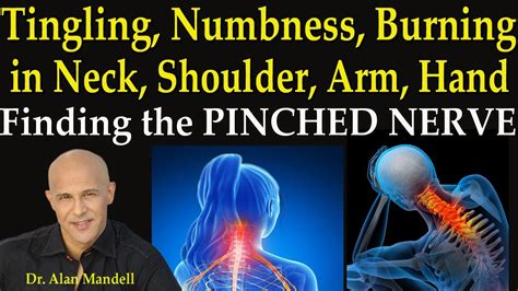 tingling numbness burning in neck shoulder arm and hand finding the pinched nerve youtube