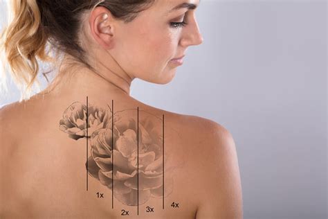Revlite Si Laser Tattoo Removal Ageless Beauty Laser And Spa Surrey Bc