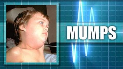 Common Cold Or A Case Of The Mumps Heres What Symptoms To Watch For