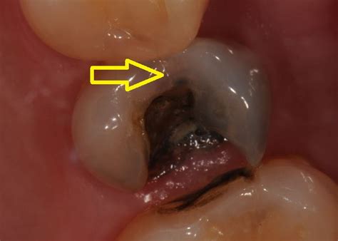 What Are My Options To Repair A Cracked Tooth