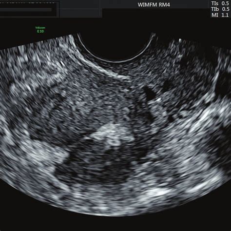 Ultrasound Image Demonstrating Hyperechoic Tissue Protruding Through