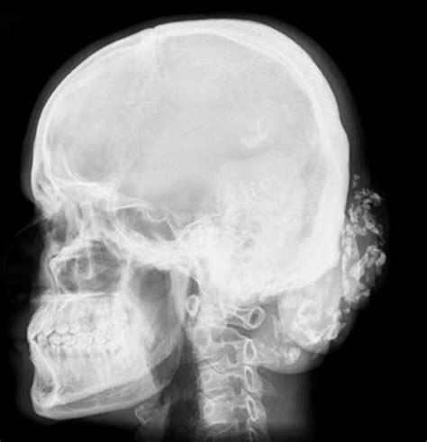 X Ray Of The Skull Showing Chunky Calcification Over The Occiput In The