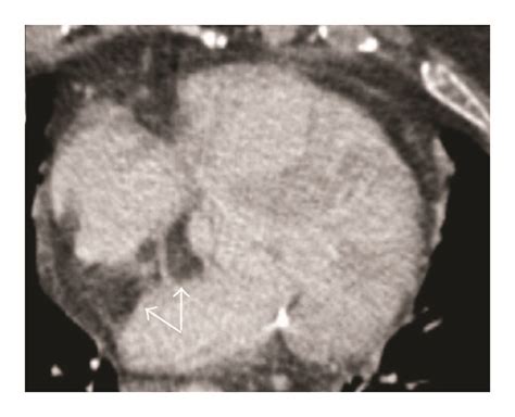 Lipomatous Hypertrophy Of The Interatrial Septum As Incidental Finding