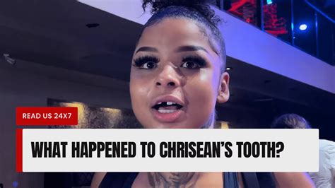 What Happened To Chriseans Tooth Revealed Read Us 24x7