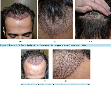 Pdf Adipose Derived Stem Cells And Growth Factors Applied On Hair Transplantation Follow Up