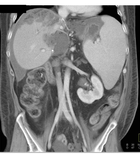 Liver Transplant With Occlusion Of Hepatic Artery And Hepatic Infarct