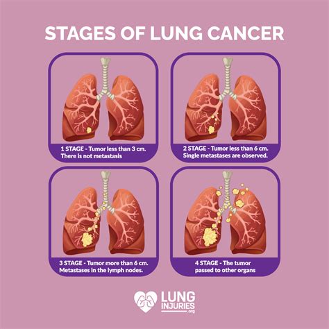 stages of lung cancer chart
