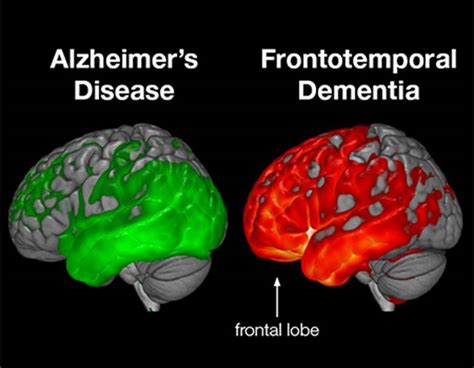 Frontotemporal Dementia Ftd Causes