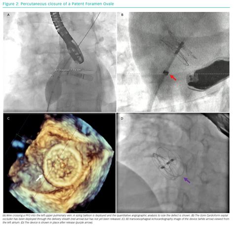 Percutaneous Closure Of A Patent Foramen Ovale Radcliffe Cardiology