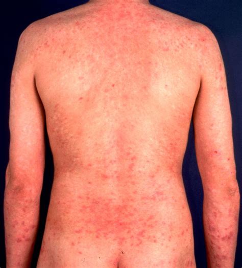 Afbeelding Van Allergic Contact Dermatitis Huidproblemen En