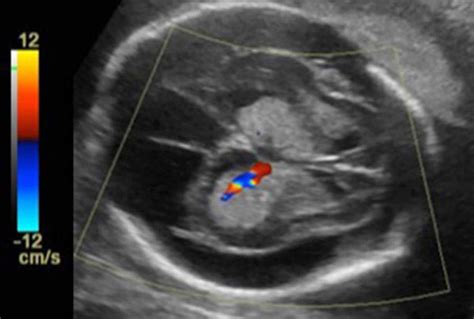 Cureus Bilateral Choroid Plexus Papillomas Diagnosed By Prenatal