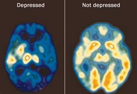 Brain Scans Show How Tms Treats Depression Smart Tms