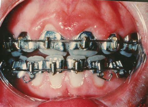 Pin On Orthodontics