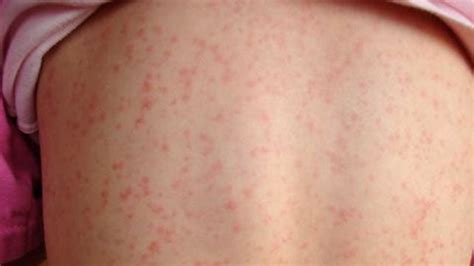 Scarlet Fever Symptoms Causes Complications And Treatment