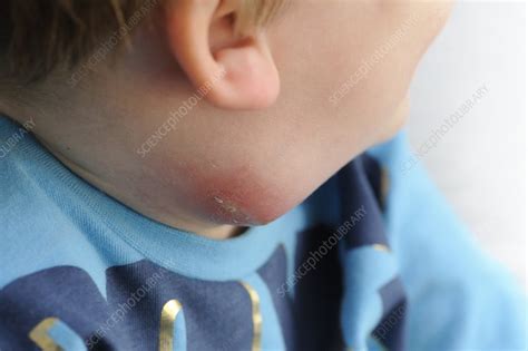 Abscess On The Neck Stock Image C0115492 Science Photo Library