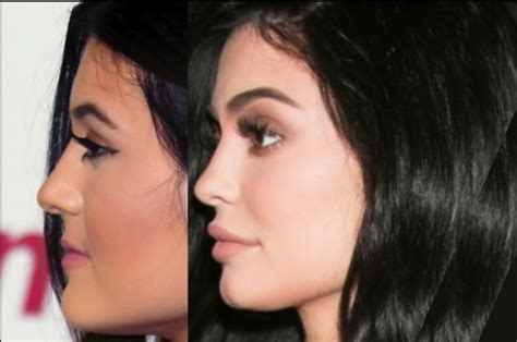Kylie Jenner Before And After All Of Her Plastic Surgery