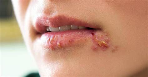 Diseases That Are Way Weirder Than You Realize Cold Sore Cold Sores