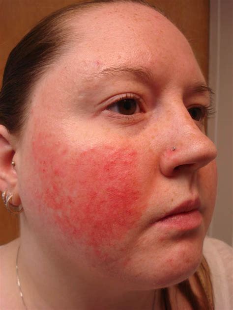 Virtual Grand Rounds In Dermatology 20 Unilateral Facial Erythema