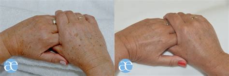 Hand Rejuvenation Ageing Hands Treatment Absolute Aesthetics