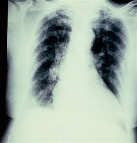 Chest X Ray Showing Bronchopneumonia Photograph By Science Photo