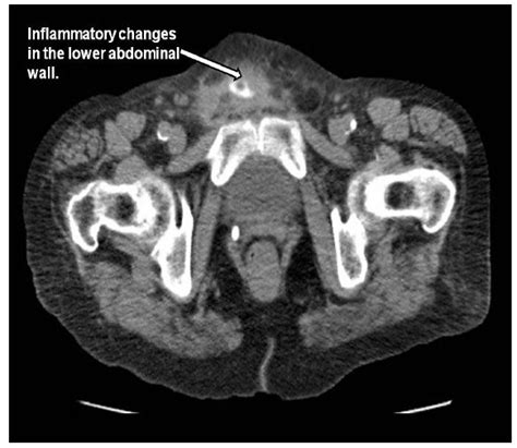 Mucinous Adenocarcinoma Of The Colon Mimicking An Abdominal Wall