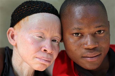 Protect The Rights Of People With Albinism Ilivewell