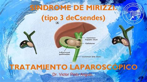 SINDROME DE MIRIZZI tratamiento laparoscópico YouTube