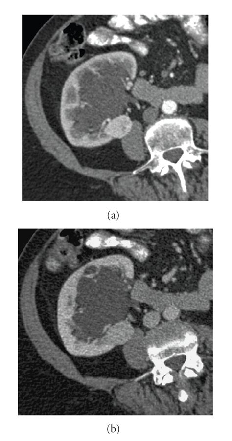 Small Hyper Vascular Renal Cell Carcinoma A Contrast Enhanced Ct