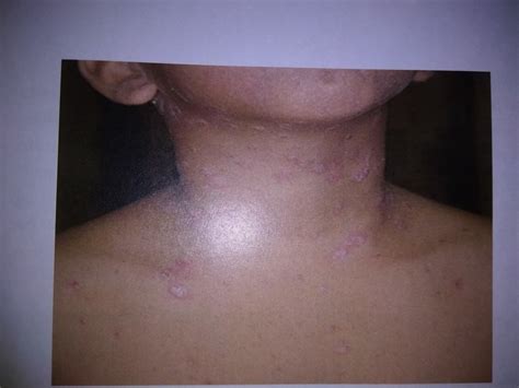 It Shows The Early Manifestations Of Guttate Psoriasis In Children