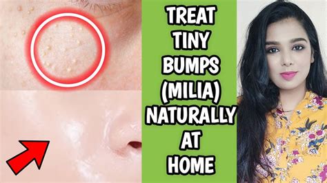 Treat Tiny Bumps Naturally At Home How To Get Rid Of Tiny Bumps On