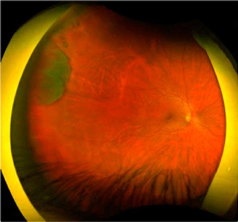 Fundus Image Of The Right Eye Showing Pars Plana Cyst Temporally From