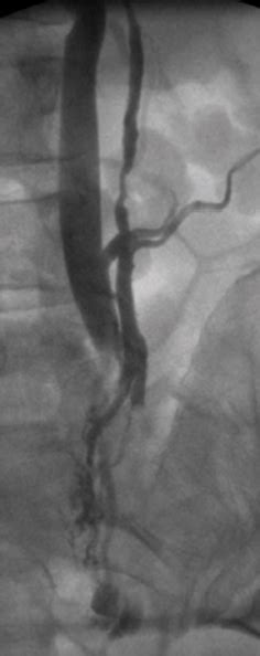 Endovascular Today Embolization For Pelvic Congestion Syndrome April