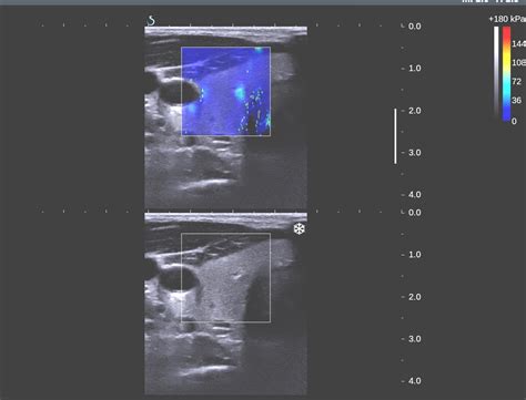 Vietnamese Medic Ultrasound Case Thyroid Cancer Dr Phan Thanh